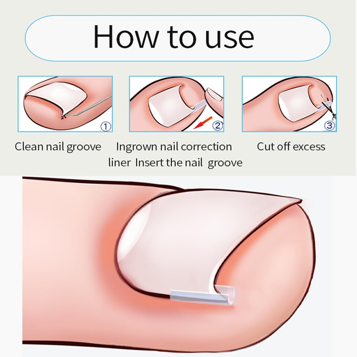 Professional Ingrown Toenail Toolkit with Breathable Ingrown Toenail Strips, Curved Toenails Corrector Patch, Painless File and Lifter for Home Pedicure Care