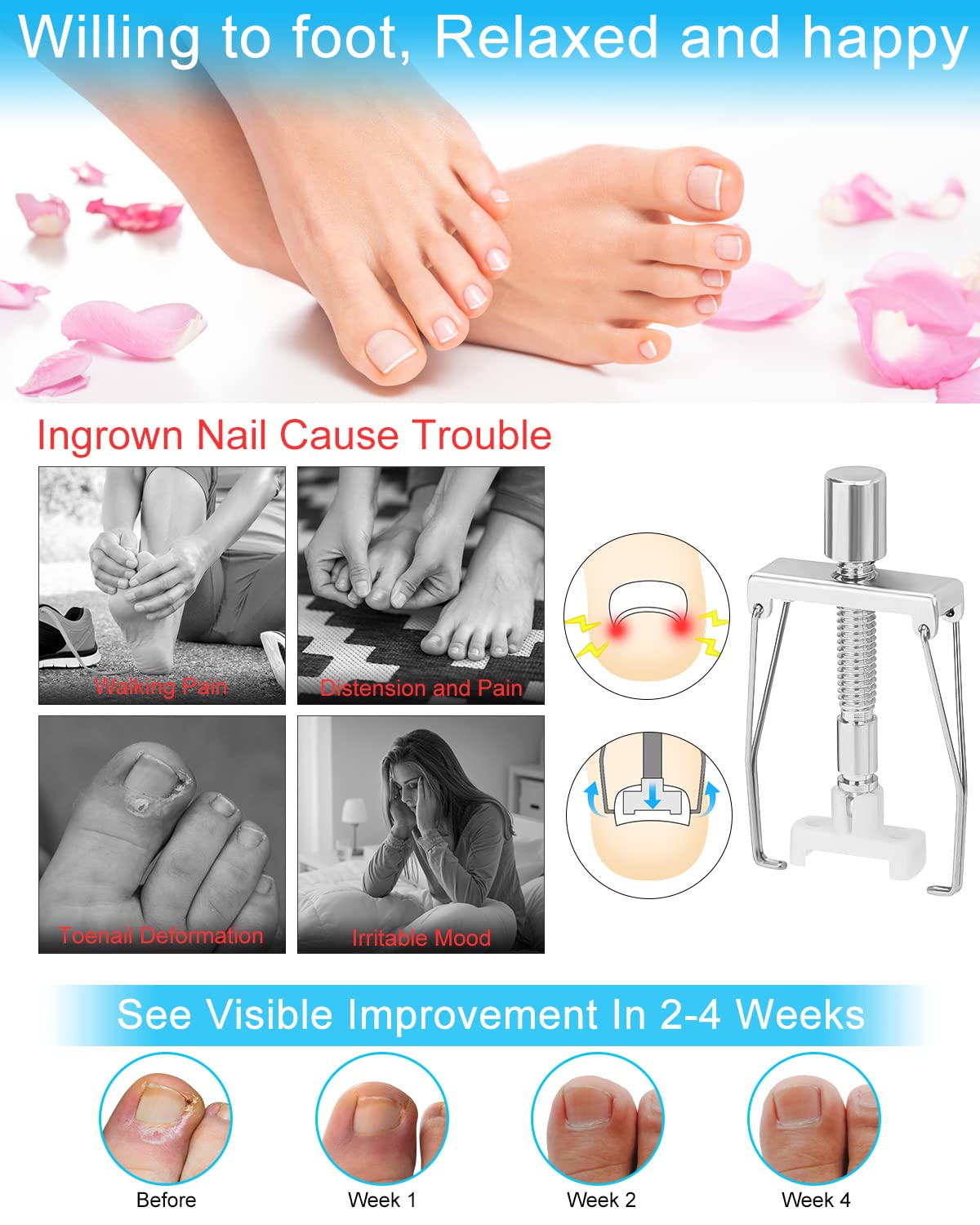 Ingrown Toenail Removal Kit, Ingrown Toenail Treatment, Ingrown Toenail Corrector Tools Come with Podiatry Toenail Braces, Ingrown Toenail Corrector Strips and Patch for Toe Pain Relief