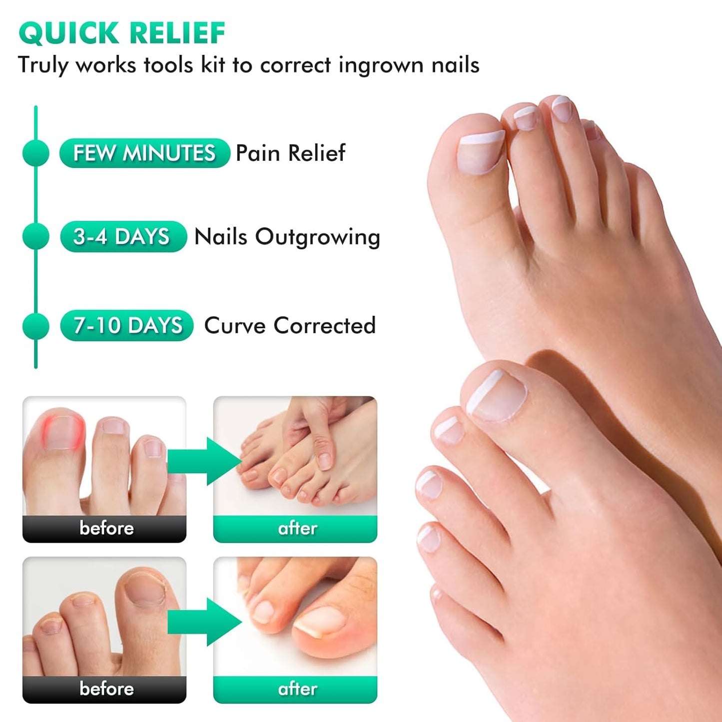 Ingrown Toenail Correctors Tripled, Quick Relief Ingrown Toenail Treatment Removal Tool Kit at Home, Curve Correct for Big Toe Ingrown Nail Outgrow Lifter Sticks To The Nail 0.59/0.66in