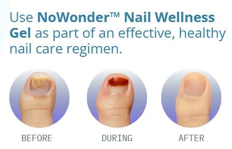 NoWonder Nail Wellness Gel | Nitric Oxide Creating Nail Renewal Solution | Supports Clearer, Healthier Nails | Non-Prescription, Safe & Easy-to-use, Nail Care, with Visible Results