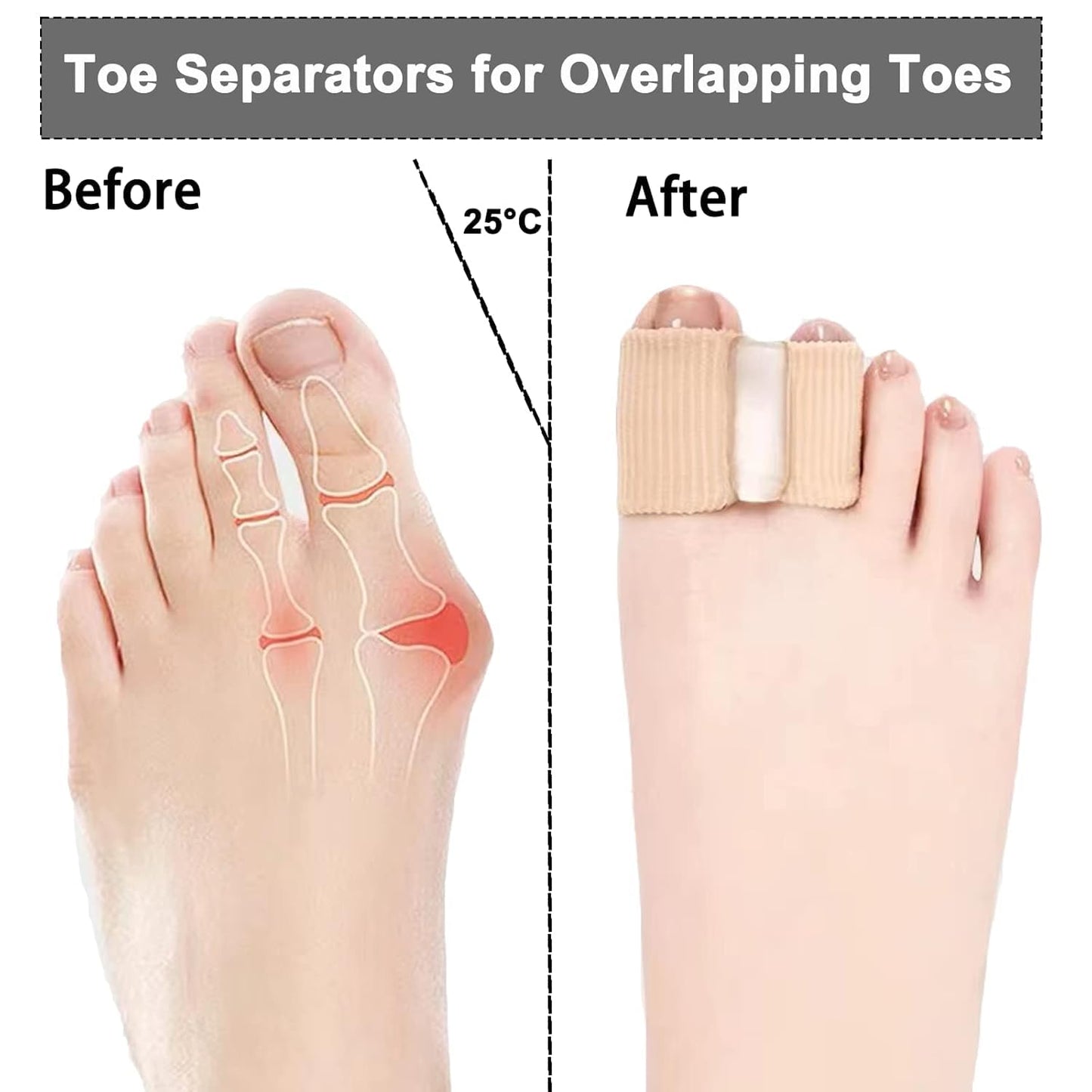 4 Packs Bunion Corrector Toe Separators for Overlapping Toes Women & Men, Gel Toe Spacers Bunion Corrector with 2 Loops for Feet, Hammer Toe Straightener for Big Toe