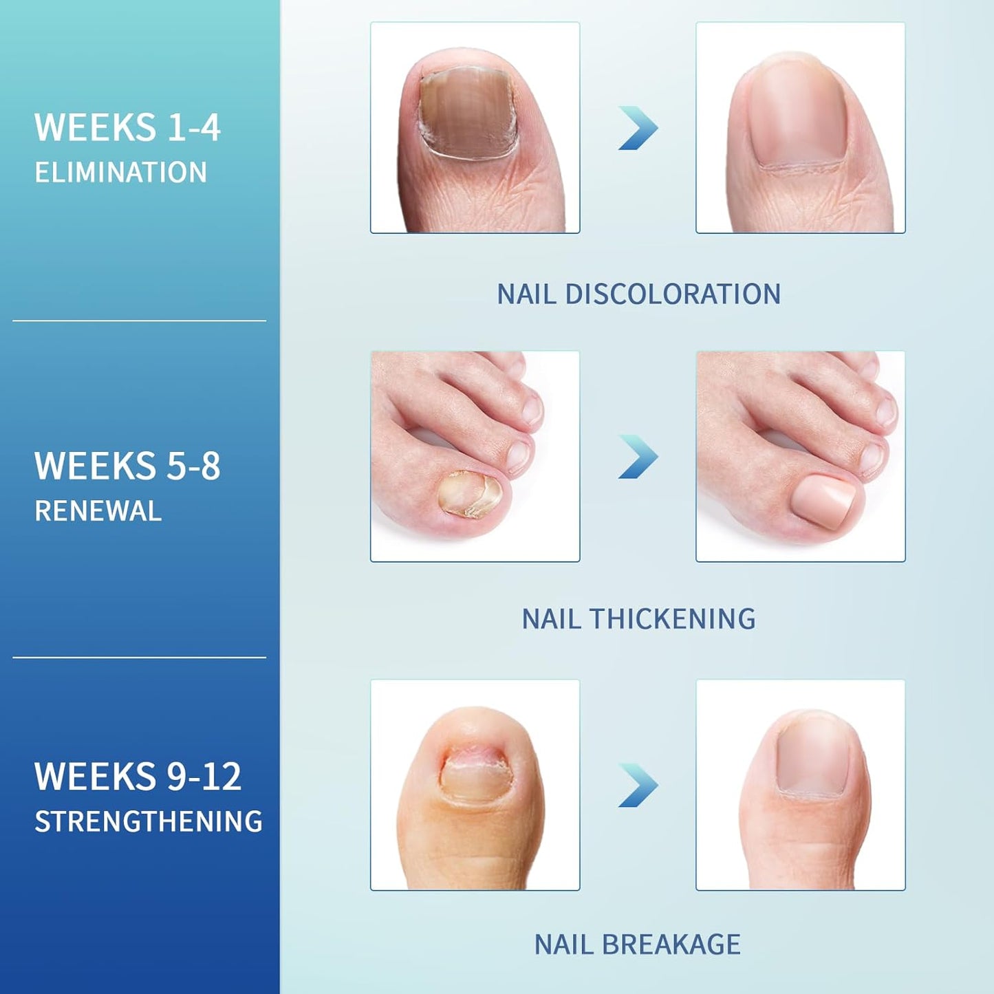 Fungal Nail Patches - 32 PCS, Toenail Fungus Treatment Extra Strength for Thick, Brittle and Discolored Toenail, Nighttime Care with Natural Ingredients, Nude-Colored Patches (Blue)