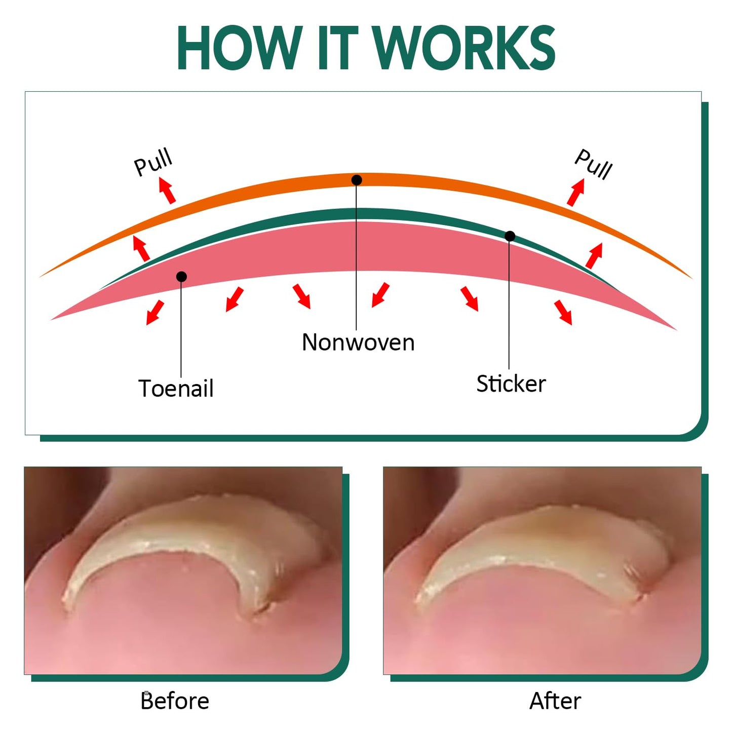 100pcs Ingrown Toenail Treatment, Breathable Ingrown Toenail Strips Ingrown Toenail Stickers, Toenail Corrector Patch with 3 Pedicure Tools for Ingrown Toenail