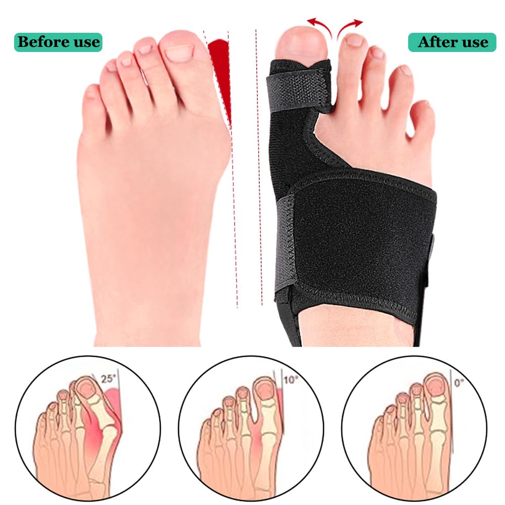 Bunion Toe Corrector Splint for Women & Men, Adjustable Bunion Straightener for Pain Relief, Big Toe Orthopedic Separator for Hallux Valgus, Hammer Toe, Day/Night Support (Left Foot)