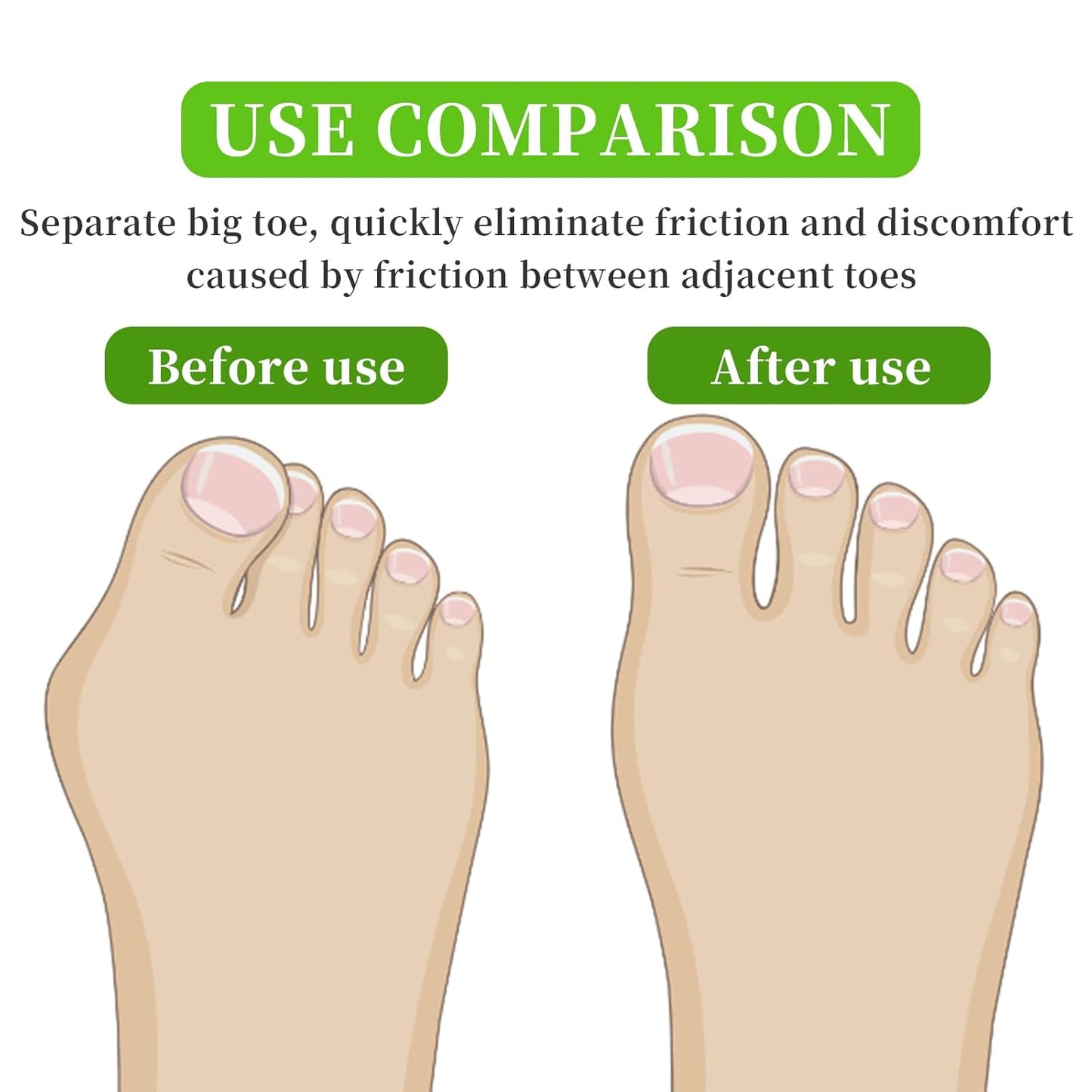 Qmagic 4PCS Hammer Toe Straightener with Aluminum Plate, Hammer Toe Straightener Corrector for Women & Men, Toe Splints & Wraps Support for Crooked, Curled, Bent Toes