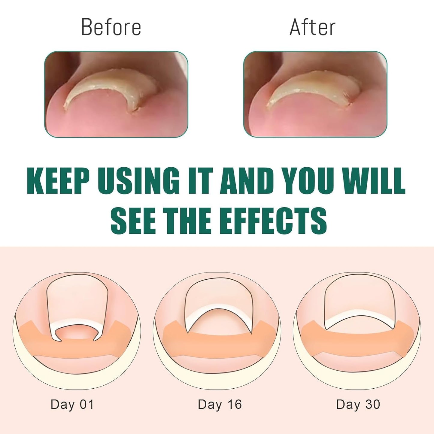 Ingrown Toenail Treatment, 60Pcs Breathable Ingrown Toenail Strips,Painless Ingrown Toenail Tool, Professional Pedicure for Ingrown Toenail, Toenail Corrector Patch