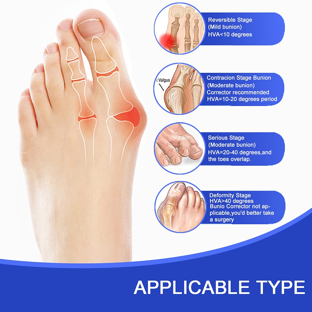 Toe Corrector Separators Bunion Splint 【2025 Updated】 Hallux Valgus Big Toes Corrector Set Bunion Brace Exercise Strap Orthopedic Kit Foot Pain Relief