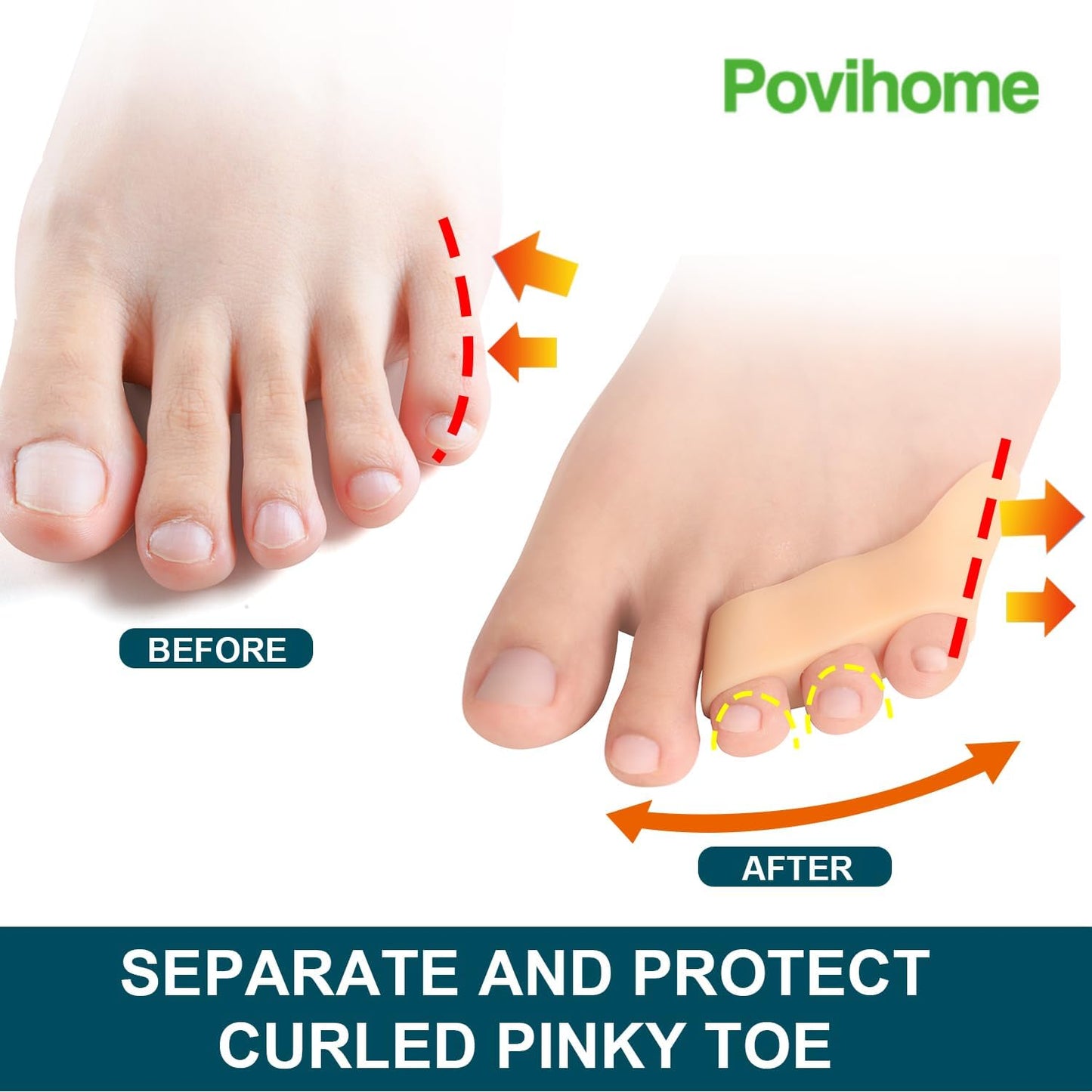 Povihome 10 Pack Pinky Toe Separator and Protectors for Overlapping Toe, Curled Pinky Toes | Spacer for Morton's Neuroma Pain Relief | Firm Support for Straightening | Beige