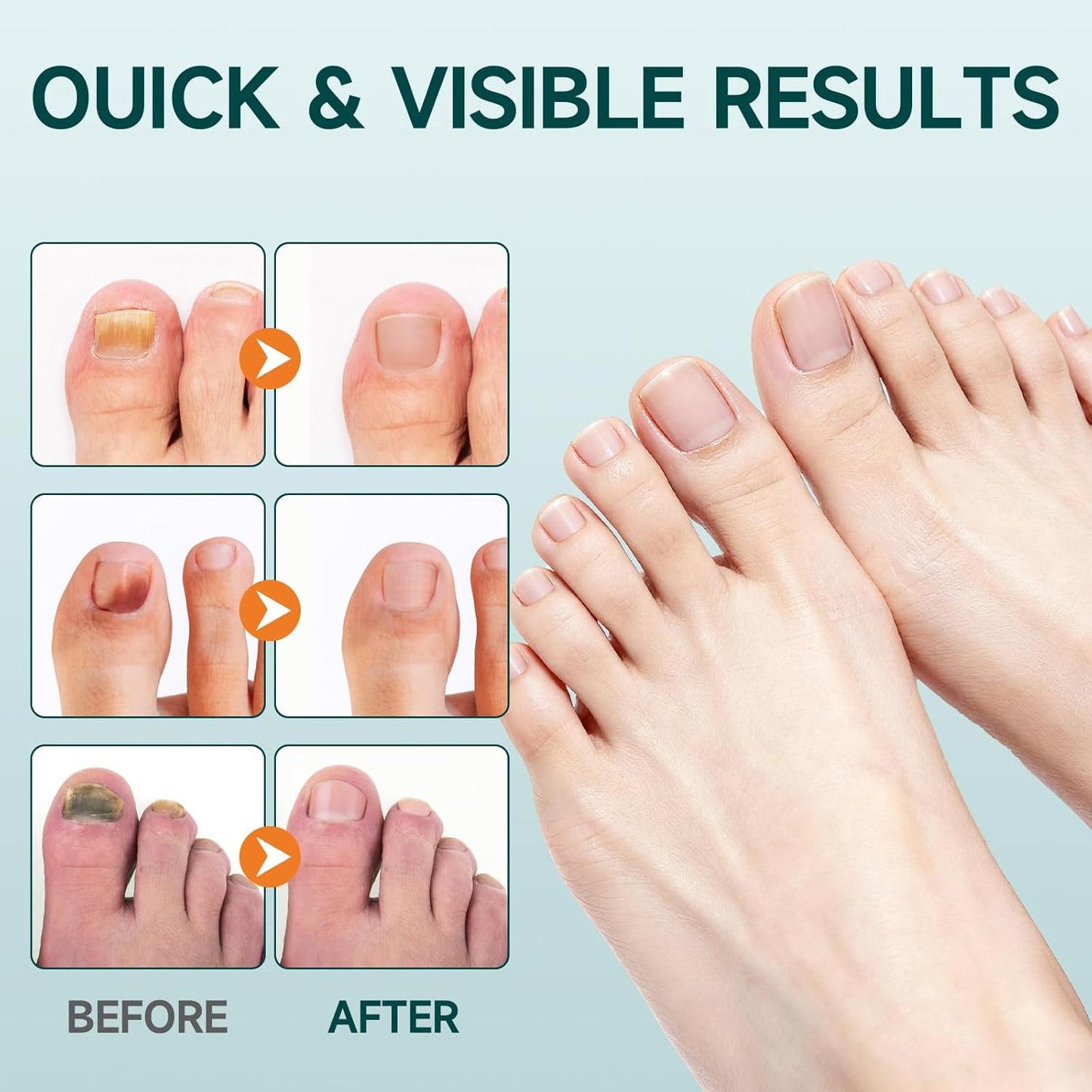 32 Pcs Fungal Nail Patches, Toenail Fungus Treatment Extra Strong Formula, Nail Repair for Damaged Nails, Overnight Renewal for Men and Women