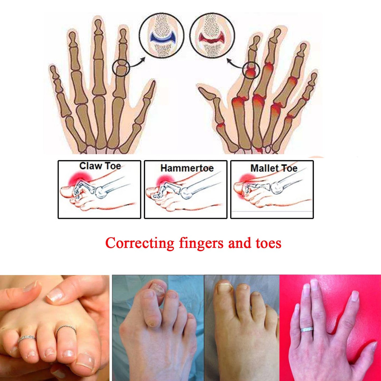 6 Pieces Broken Toe Wrap, Hammer Toe, Elastic Fabric Toe Splint Toe Straightener, Toe Cushioned Bandages Finger Protectors Straightener Hammer Toe Separators