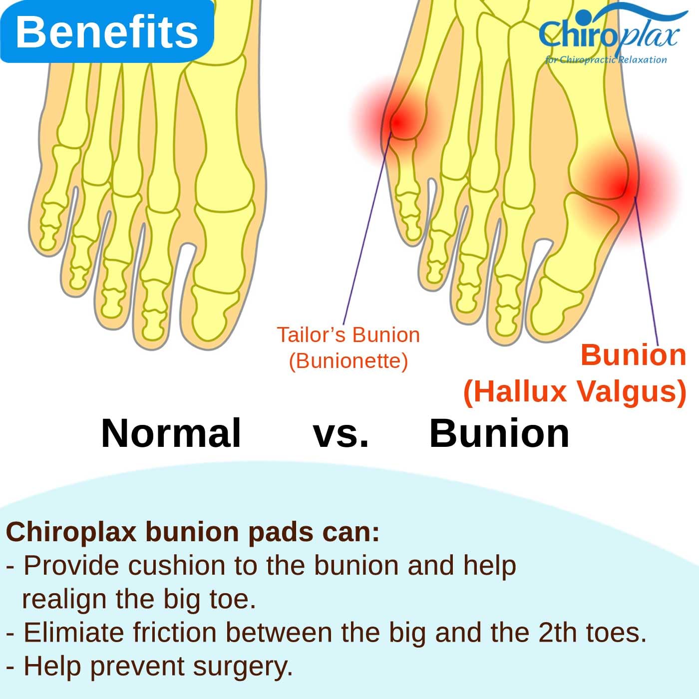 Chiroplax Bunion Corrector for Women & Men Relief Cushion Pads Hallux Valgus Guard Toe Separator Straightener Splint Protector Shield Spacer Sleeve Cover (4 Pads w/Shims, Small)