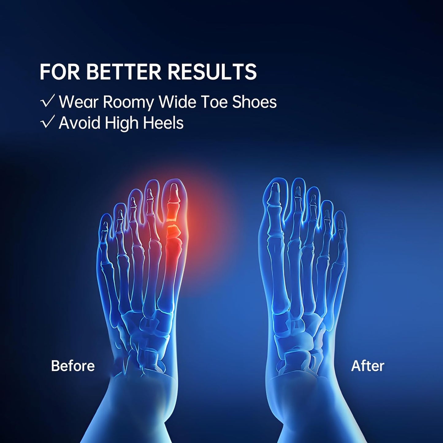 Bunion Toe Corrector Spacer for Women, Pack of 10 Soft Gel Big Toe Separators for Bunion Relief