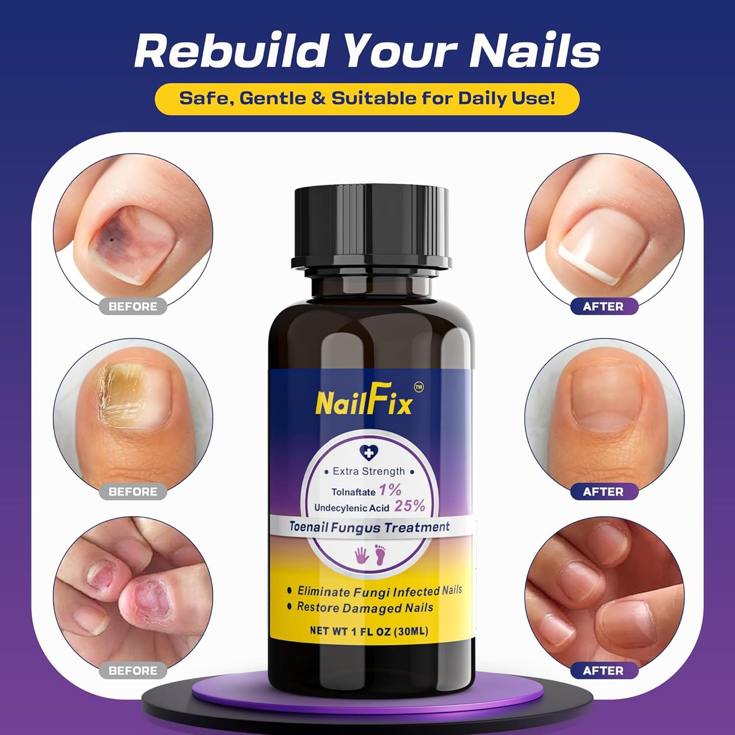 Toenail Fungus Treatment Extra Strength - Upgraded Toe Nail Fungus Treatments, Antifungal Nail Treatment with 25% Undecylenic Acid & Tea Tree Oil - Damaged Nails Foot Fungus Treatment Extra Strength