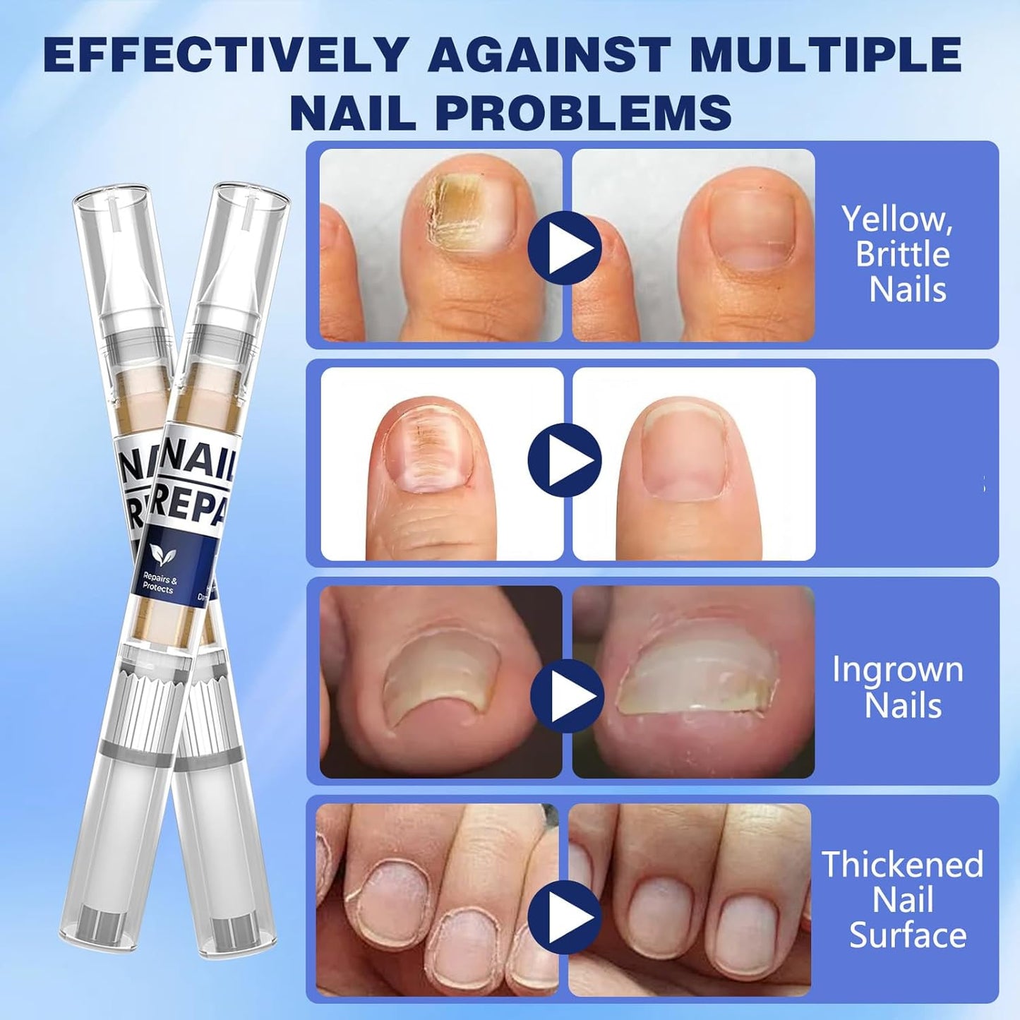 Toenail Treatment Extra Strength Pen for Toenail & Finger, More Pure Natural Plant Extracts, for Damaged Nail, Nail Repair Pen-4 pcs