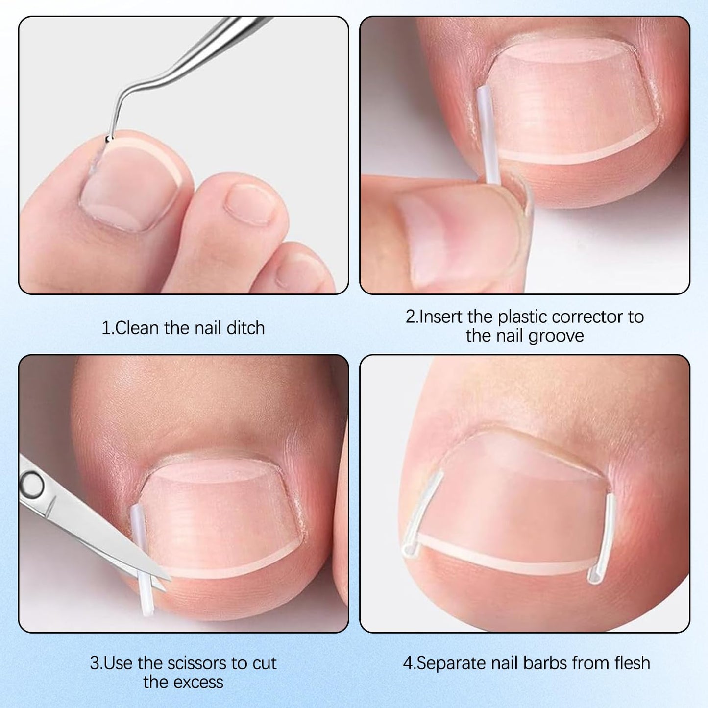 Professional Ingrown Toenail Corrector Set with Breathable Ingrown Toenail Strips,Upgraded Ingrown Toenail Removal Kit,Curved Toenails Corrector Patch,Pedicure Tools,Ingrown Nail Tool for Home Use