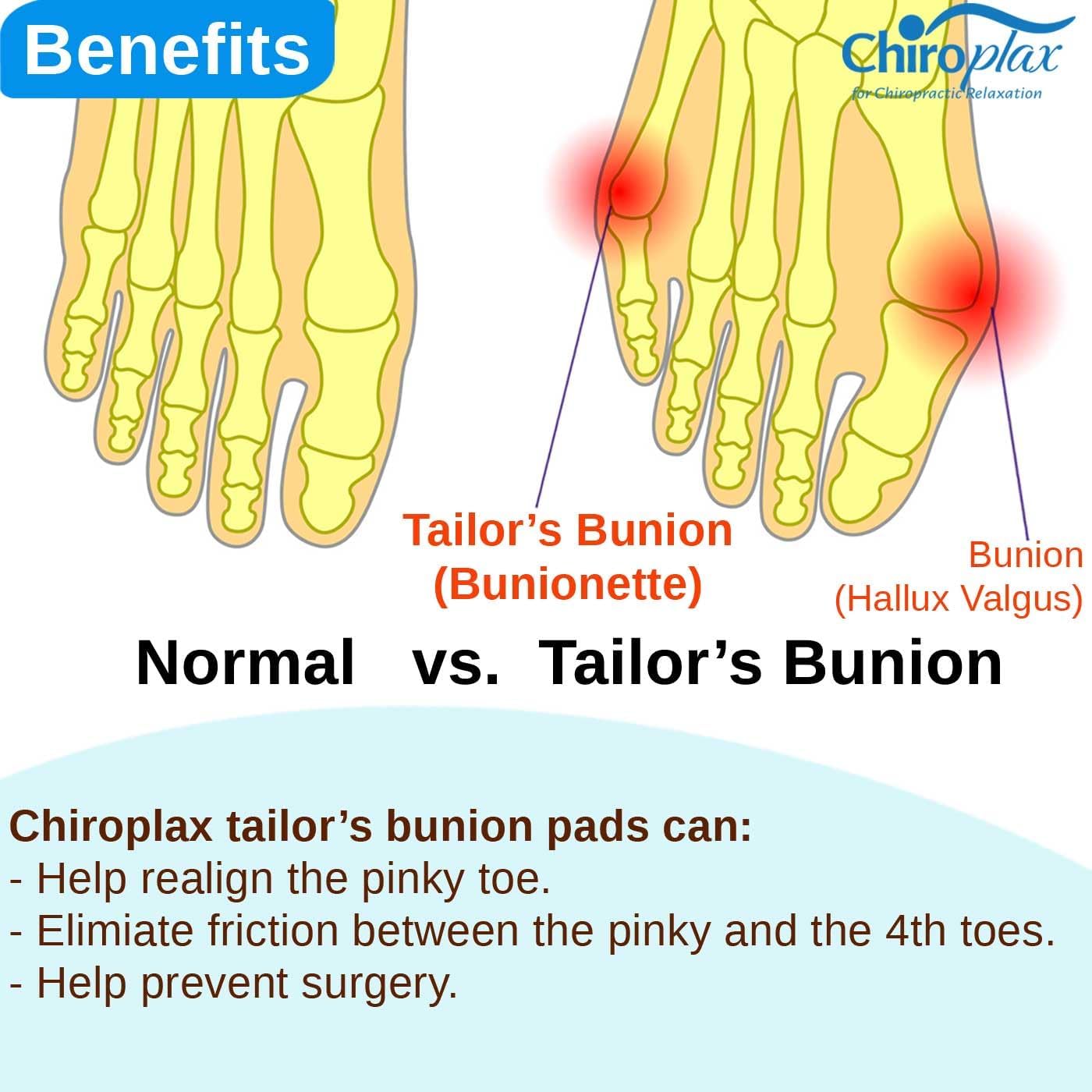Chiroplax Tailor's Bunion Corrector Pads Bunionette Pain Relief Silicone Pinky Toe Straightener Separator Spacer Sleeve Cushion Splint Protector for Men & Women (4 Pads, Shims - Size Small)