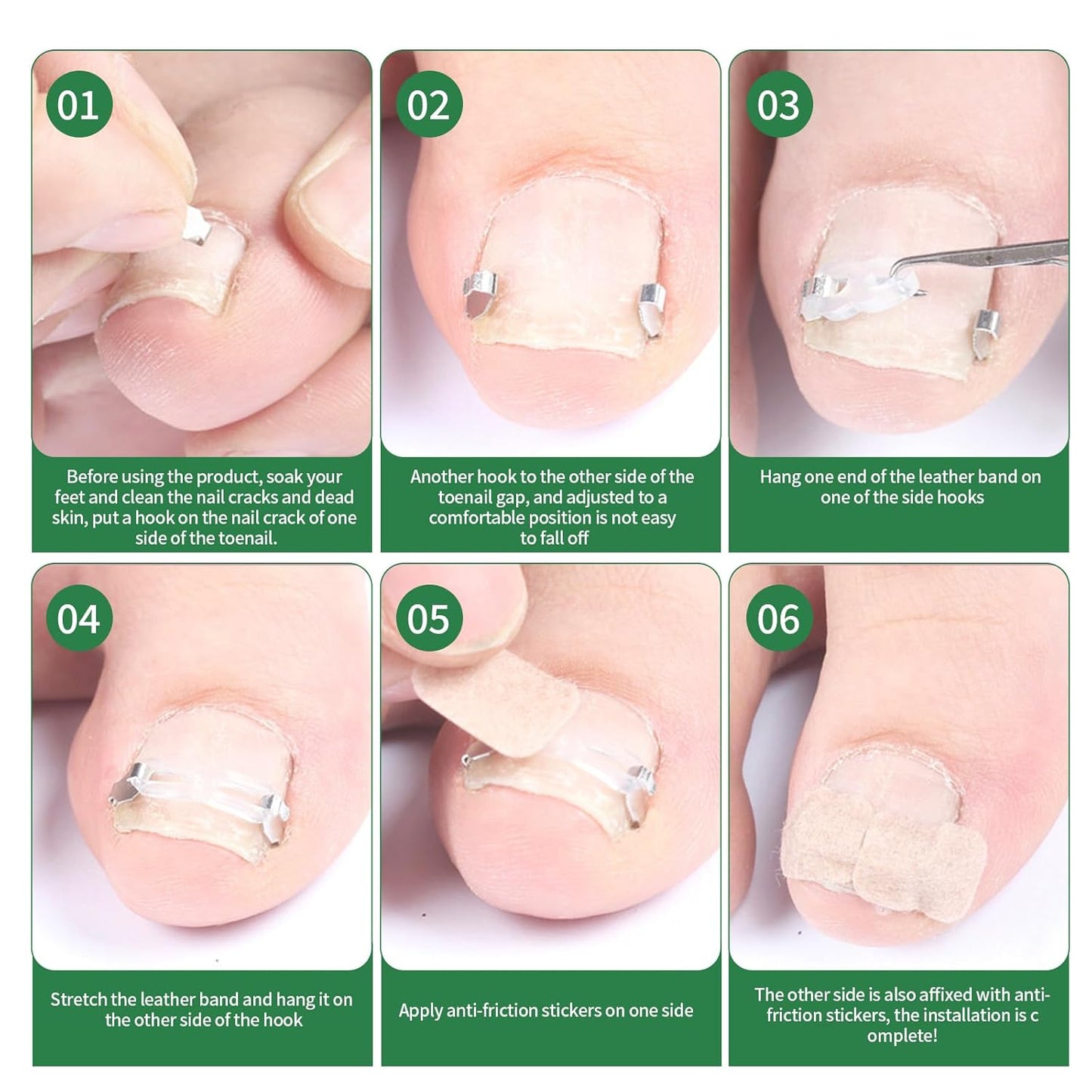 Ingrown Toenail Treatment, 10 packs Ingrown Toenail Corrector, Ingrown Toenail Removal Kit for Curved Nail Repair, Corrector for Man and Women All Size Toenail