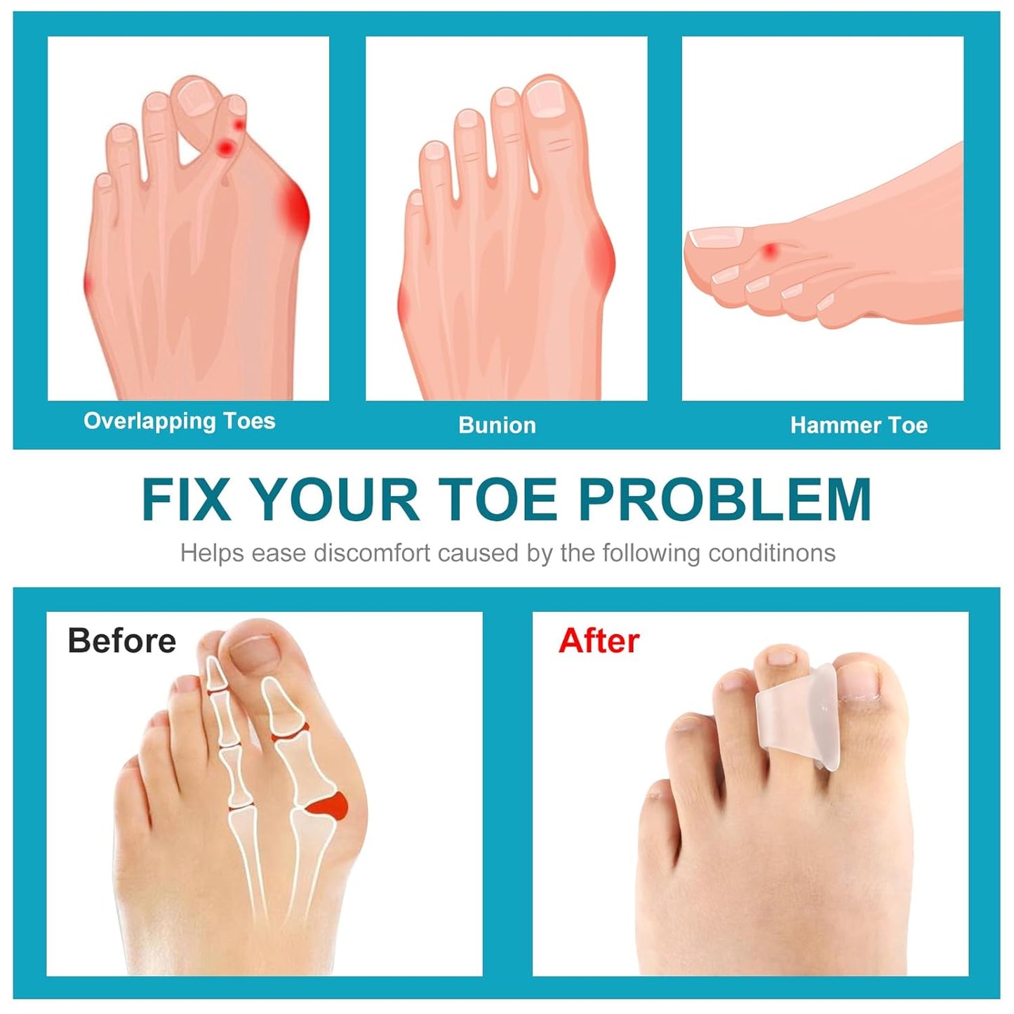 6Pcs Hammer Toe Straightener Corrector,Toe Straighteners for Curled Toes,Toe Spacers for Women Men Hammertoe Corrector for Crooked,Bunion,Hammer Toes(Clear Large Size)