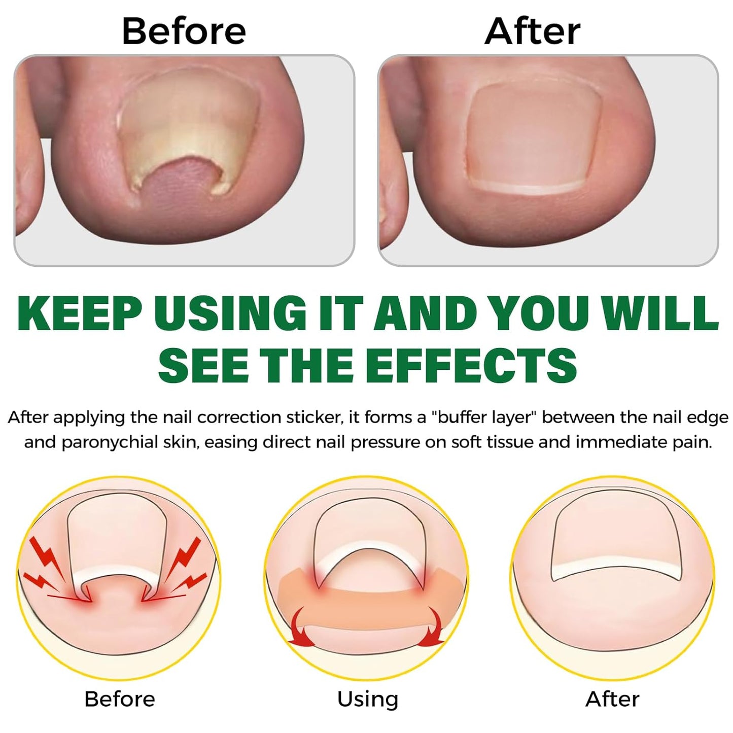Ingrown Toenail Treatment,100 Pcs Breathable Ingrown Toenail Strips-Toenail Lifter and Small Scissors, Painless Ingrown Toenail Tool, Professional Pedicure for Ingrown Toenail, Toenail Corrector Patch