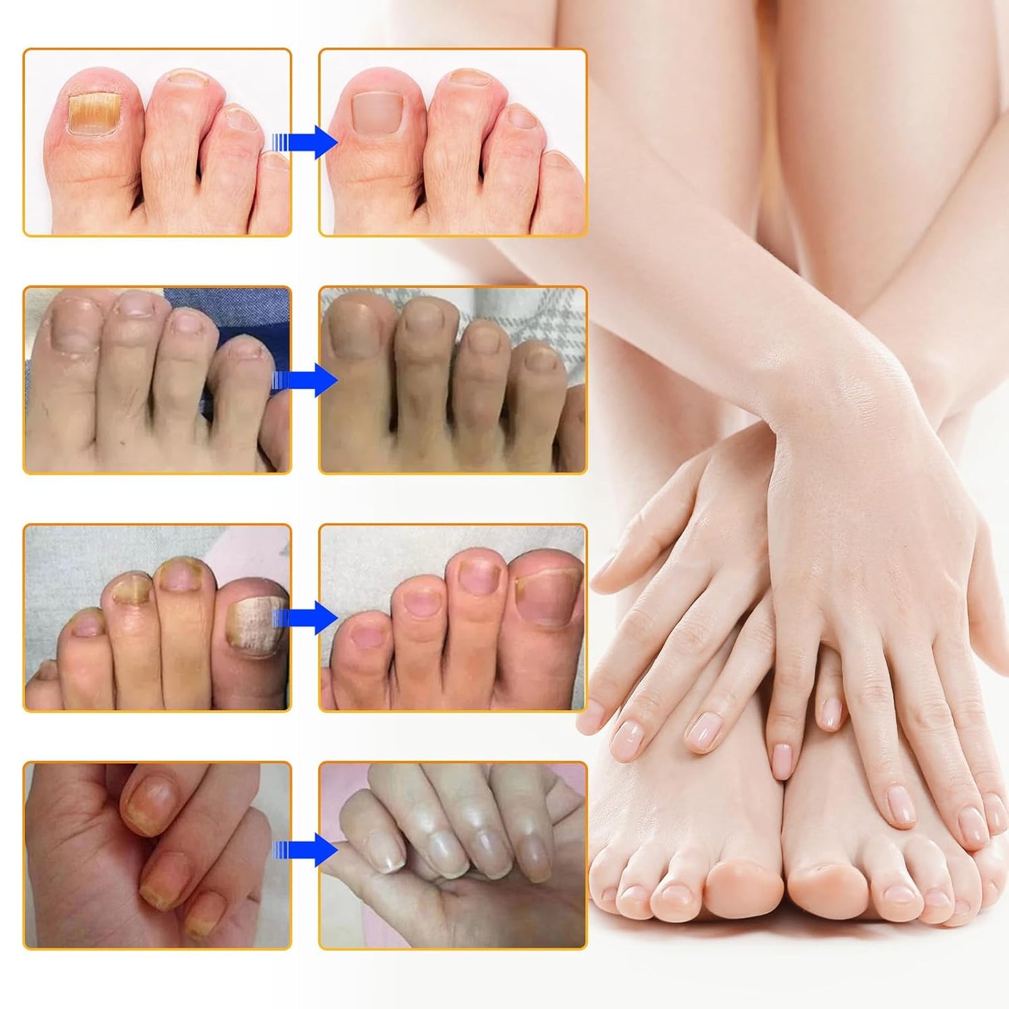 Toenail Treatment Extra Strength-8-Hrs Overnight Nail Repair,ingrown toenail treatment,Strengthens Brittle Nails,Improves Texture & Thickening Hypoallergenic Easy (32 Patch)