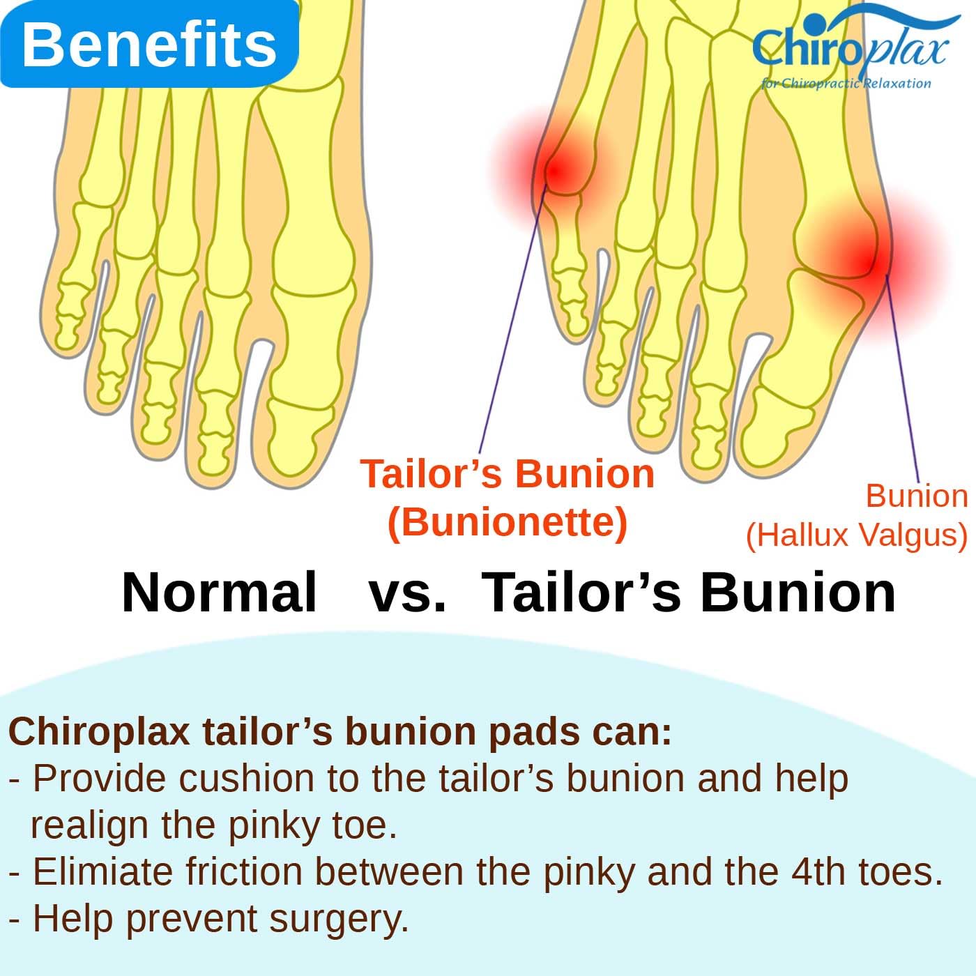 Chiroplax Tailor's Bunion Corrector Pad Bunionette Straightener Separator Cushion Pinky Toe Protector Shield Pain Relief Spacer Splint Cover Guard (Medium, 6 Pack)