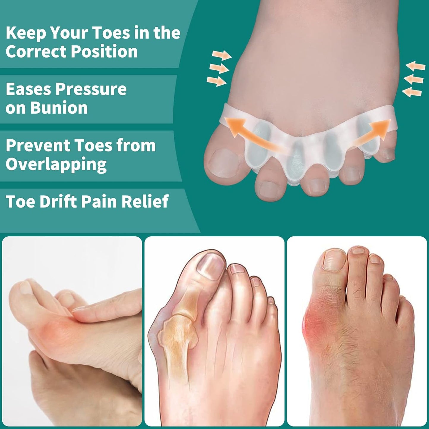 Pack of 10 Toe Separator, Silicone Toe Spacers for Correct Toe Alignment, Toe Spreader for Bunions Correct, Restore Overlapping Toes to Original Shape(Size: XL)