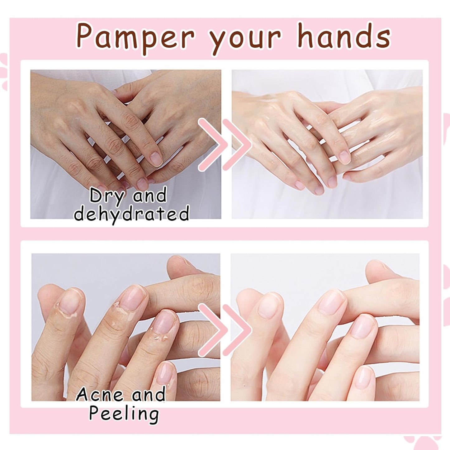 Hand Masks, 6 Pairs Hydrating Exfoliating Hand Peeling Mask, Smooth Hand Masks Moisturizing Gloves Overnight for Dry, Rough, Cracked Hands, Hand Skin Moisturizer Glove for Women Men（F