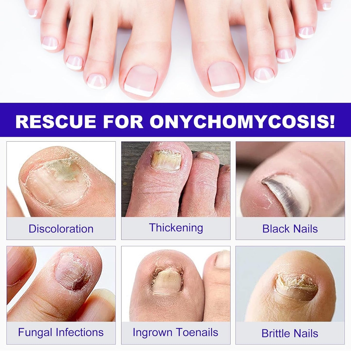 Toenail Fungus Treatment Extra Strength, 24 Pcs Fungal Nail Patches for Toenail Fungus Treatment Overnight, Nail Repair for Damaged Nails, Toenails Care Supplies, Restore Discoloration and Thickness
