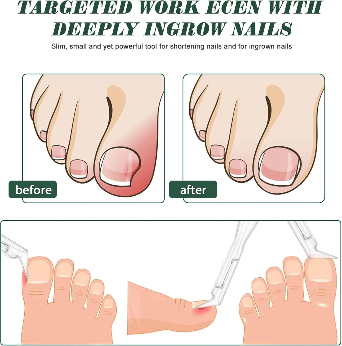 FVION Toenail Clipper Straight Blade, Professional Toe Nail Clipper for Senior, Ingrown Toenail Tool for Thick Ingrown Nails