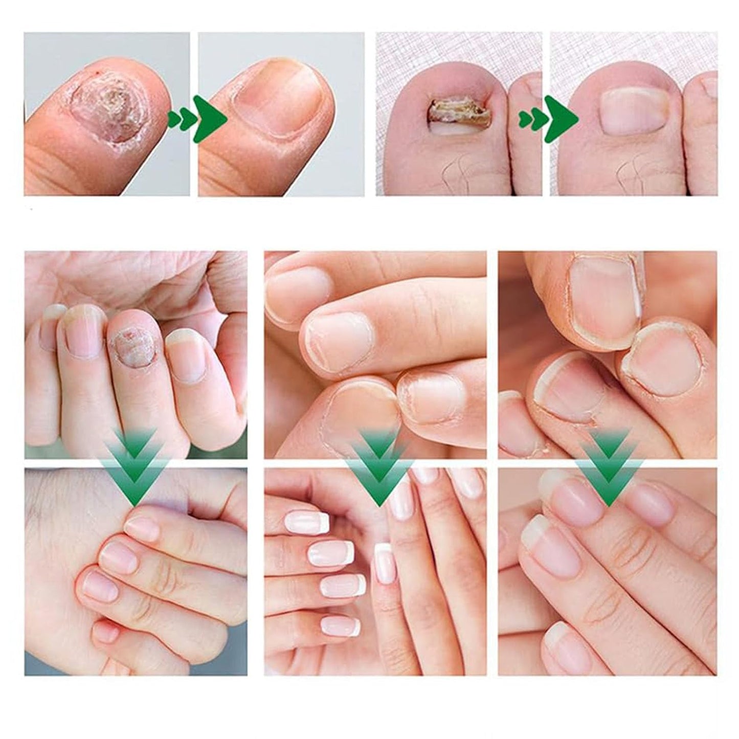 Nail Treatment Gel, Nail Growth Serum for Repair & Strengthener (1)