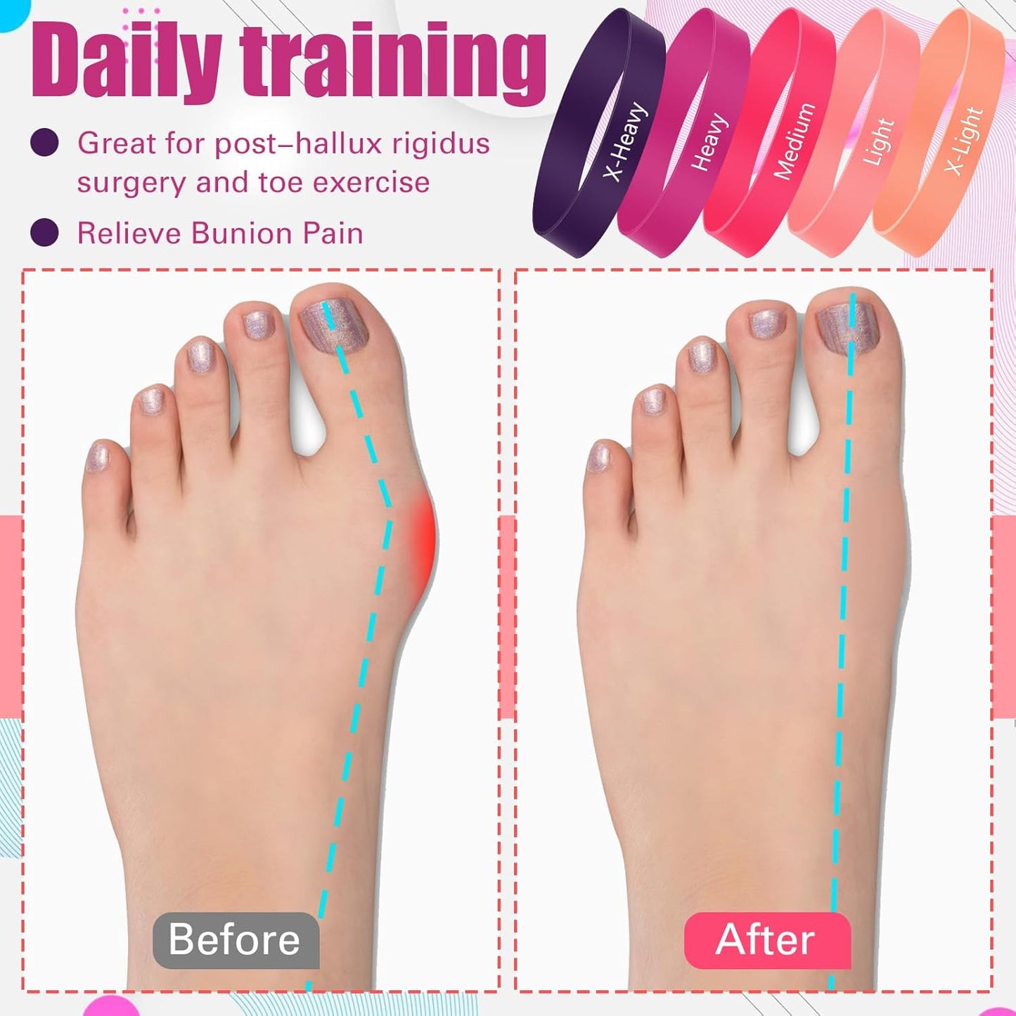 Set of 5 Toe Stretcher Bands for Bunions Correction Foot Big Toe Spacers Resistance Straightener Loop Bands with Carry Bag for Women Men Hallux Valgus Alignment Yoga Exercise(Pink)