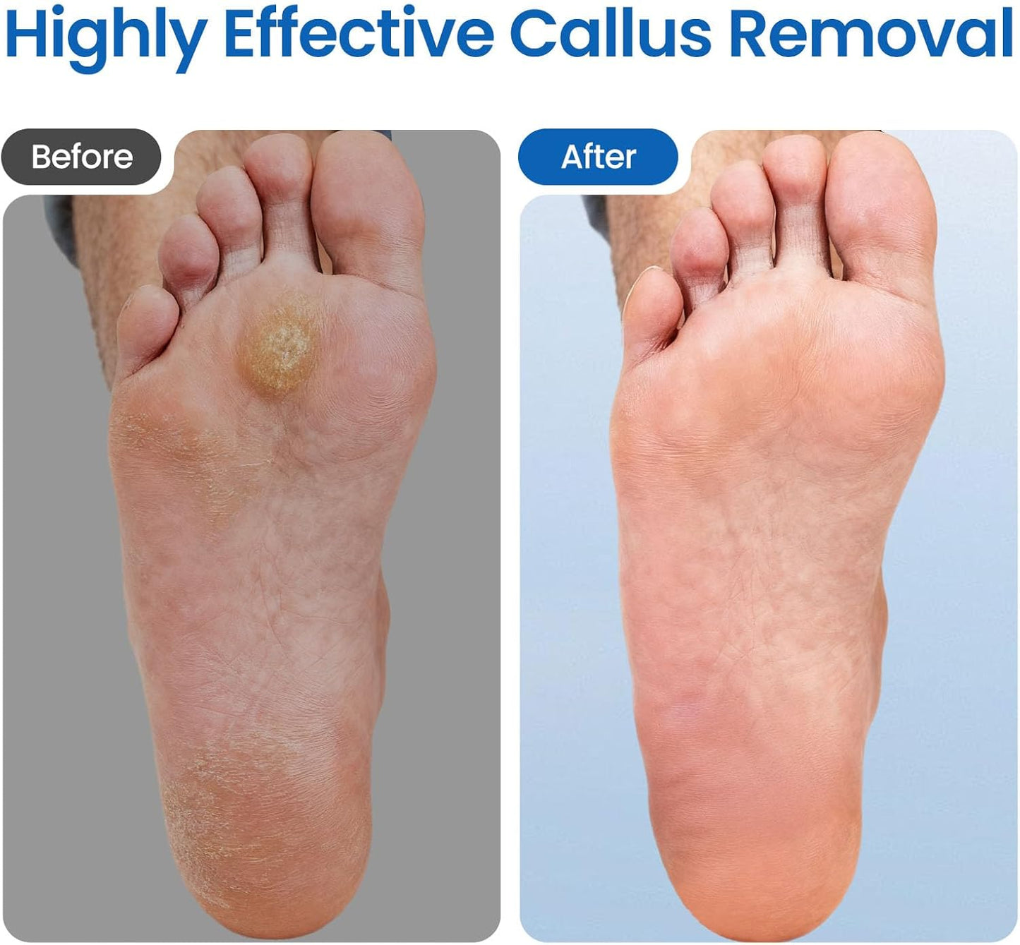 Electric Foot Callus Remover-60pcs Replacement Sandpaper Discs, 1200RPM Speed Adjustment, Metal Body, Callus & Dead Skin Removal