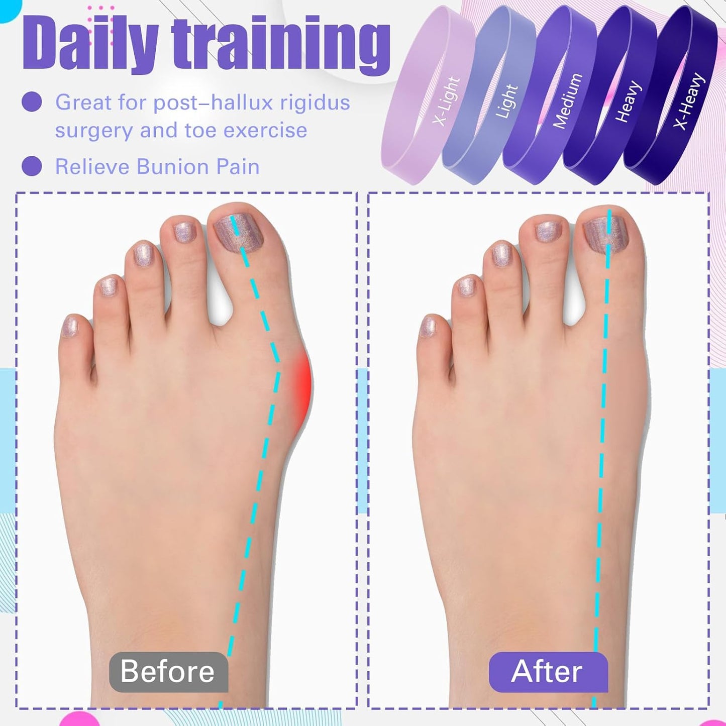 Set of 5 Toe Stretcher Bands for Bunions Correction Foot Big Toe Spacers Resistance Straightener Loop Bands with Carry Bag for Women Men Hallux Valgus Alignment Yoga Exercise(Purple)
