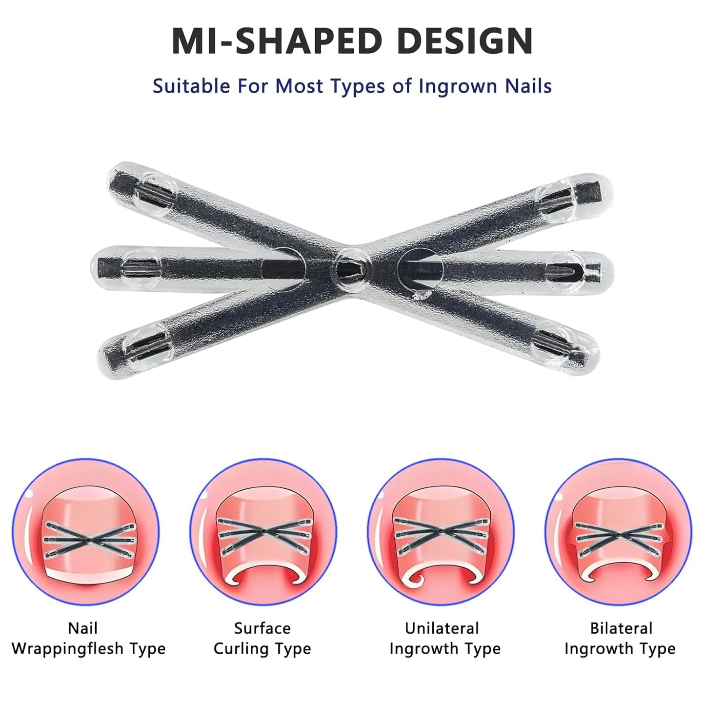 Upgraded MI-shaped Design Titanium Alloy Ingrown Toenail Corrector for Quick Pain Relief, Ingrown Toenail Treatment and Removal Tool Kit for Effective Curved Nail Repair, 6pcs