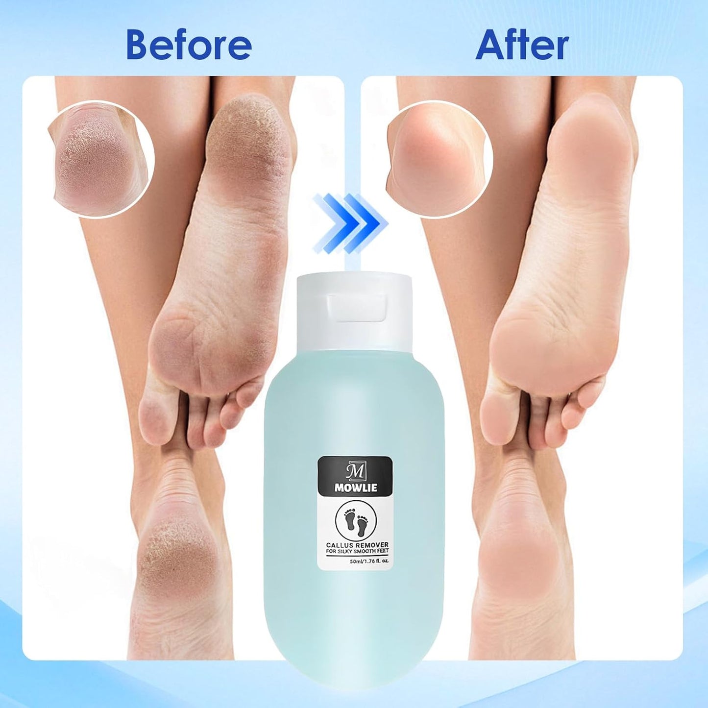 Professional Callus Remover for Feet – Extra Strength Foot Callus Remover Gel with 2 Glass Sandpaper Discs for Electric Foot Callus Remover,Foot Care kit - 50 ml/1.76 fl.oz