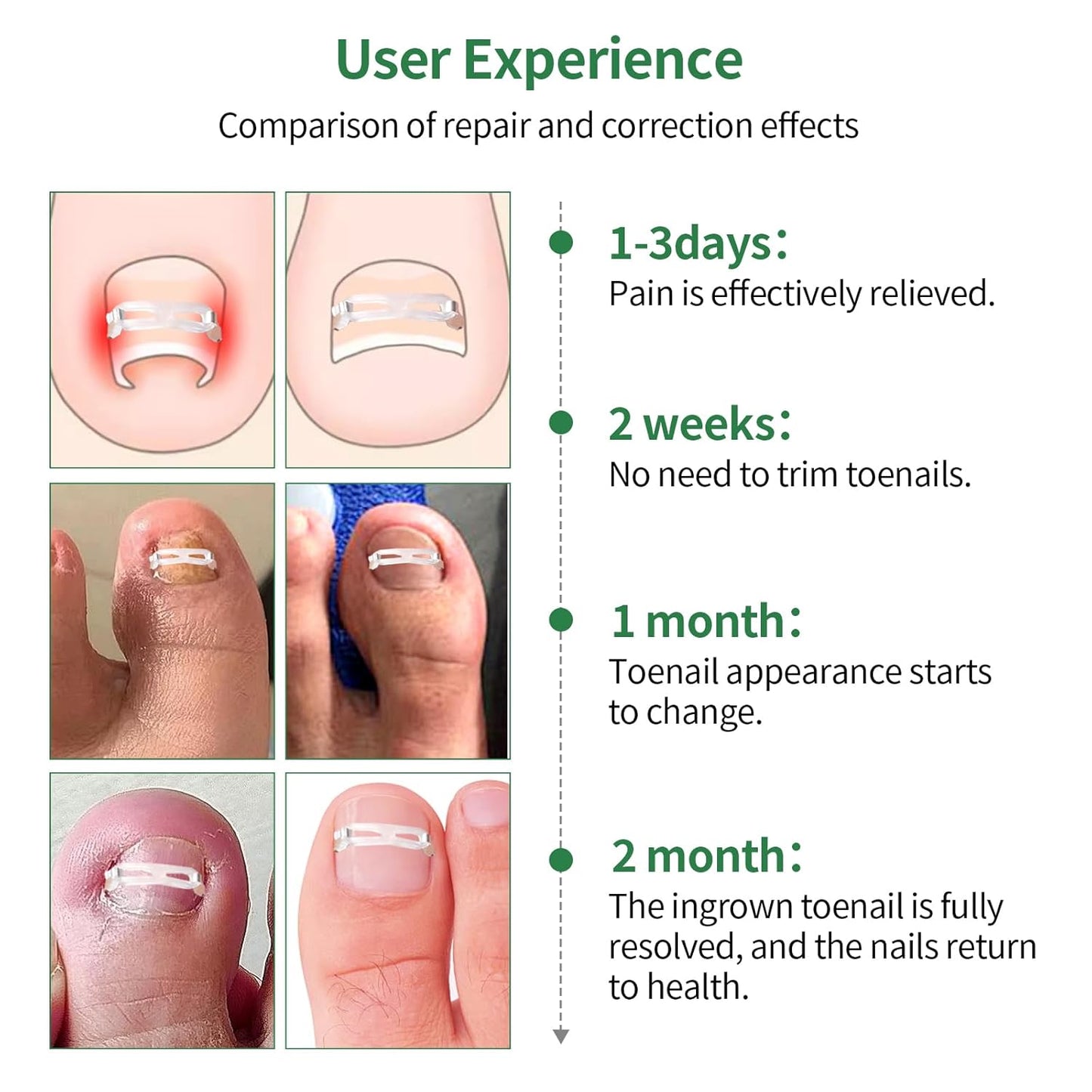 Ingrown Toenail Treatment, 10 packs Ingrown Toenail Corrector, Ingrown Toenail Removal Kit for Curved Nail Repair, Corrector for Man and Women All Size Toenail