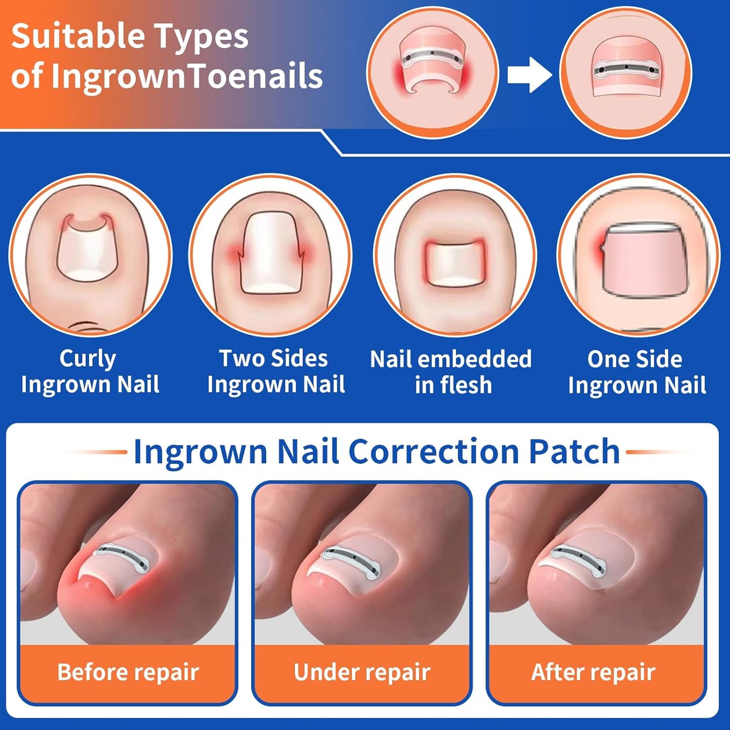 5 Sizes, 10 Pcs - Ingrown Toenail Treatment Kit, Titanium Alloy Ingrown Toenail Removal Kit, Nails Corrector Tool & Remover Strips - Ingrown Toe Nail Quick Relief(0.51/0.59/0.67/0.7/0.74 inches)