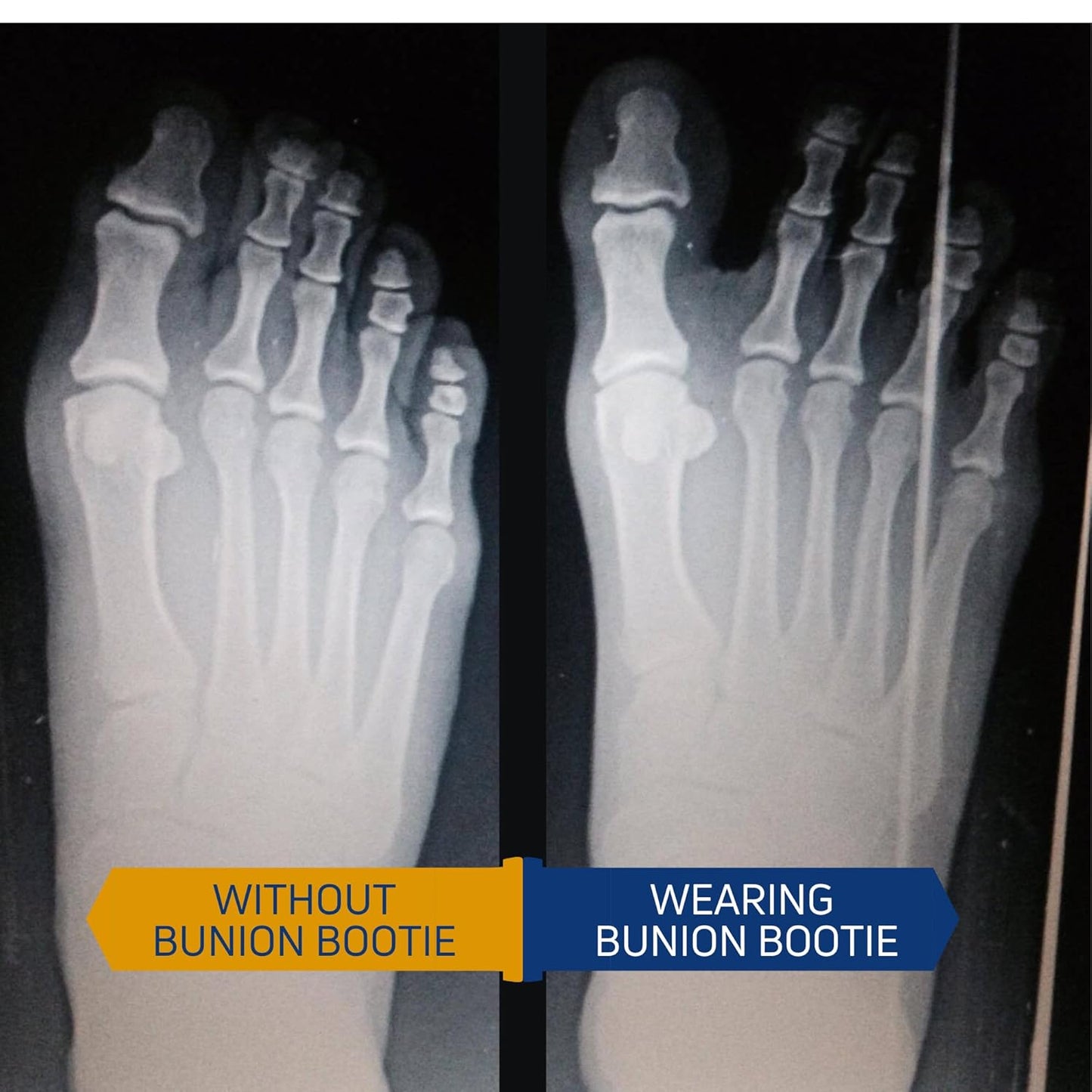 Bunion Corrector for Women Big Toe – Flexible Splint Straightener Sock – Ultra-Thin Bunion Relief Sleeve for All Shoe Types – For Hallux Valgus & Overlapping Toes. Small-Left