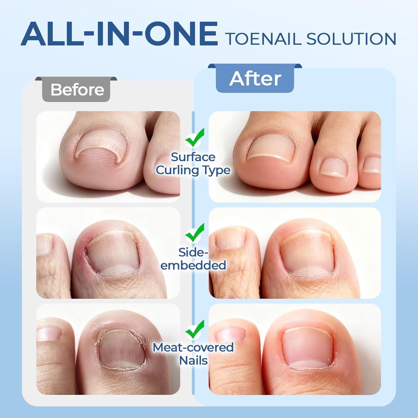 Ingrown Toenail Corrector Set with Correction Strips, Professional Ingrown Toenail Removal Kit Pedicure Tool Set, In Grown Toe Nail Remover Curve Tape at Home for Men Women