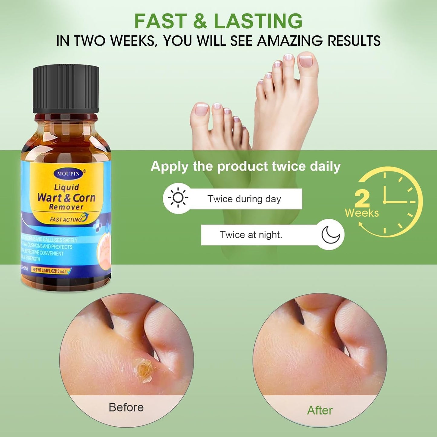 MQFORU Corn Remover, Corn Removers for Toes, Callus Remover for Fast-Acting Foot Care - Plantar and Common Callus Remover 15ML (0.51 oz 15 pcs Pads)