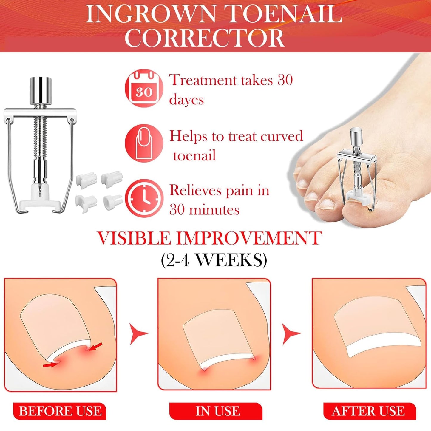 Ingrown Toenail Removal Kit, Professional Ingrown Toenail Treatment, Ingrown Toenail Tools Kit with Ingrown Toenail Corrector Drops, Toenail Clipper, Corrector Patch, Stainless Steel Pedicure Tool Set
