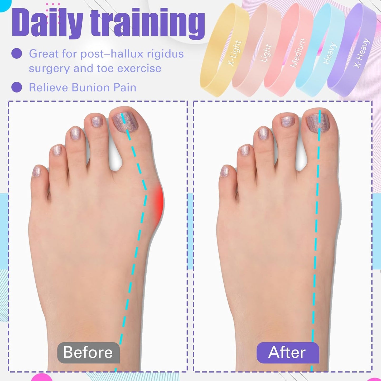 Set of 5 Toe Stretcher Bands for Bunions Correction Foot Big Toe Spacers Resistance Straightener Loop Bands with Carry Bag for Women Men Hallux Valgus Alignment Yoga Exercise (Pastel)