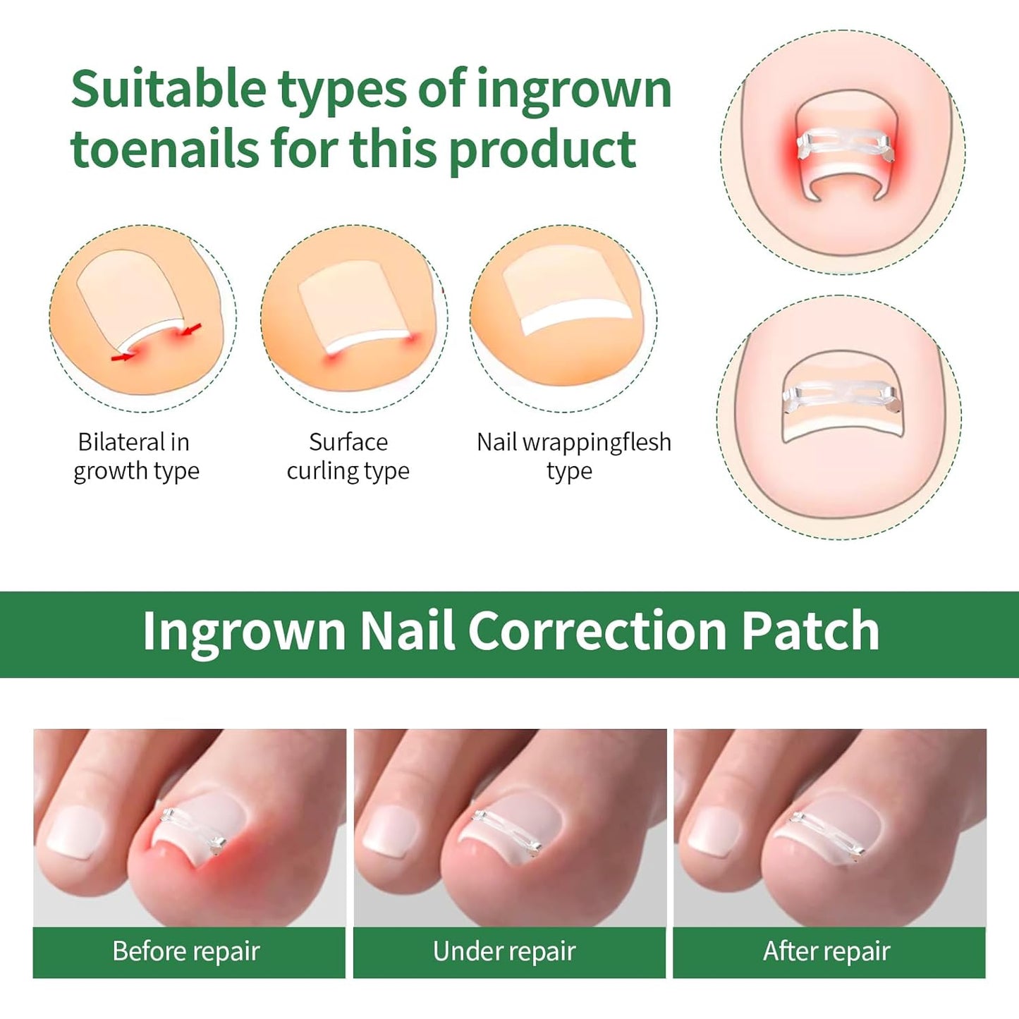 Ingrown Toenail Treatment, 10 packs Ingrown Toenail Corrector, Ingrown Toenail Removal Kit for Curved Nail Repair, Corrector for Man and Women All Size Toenail