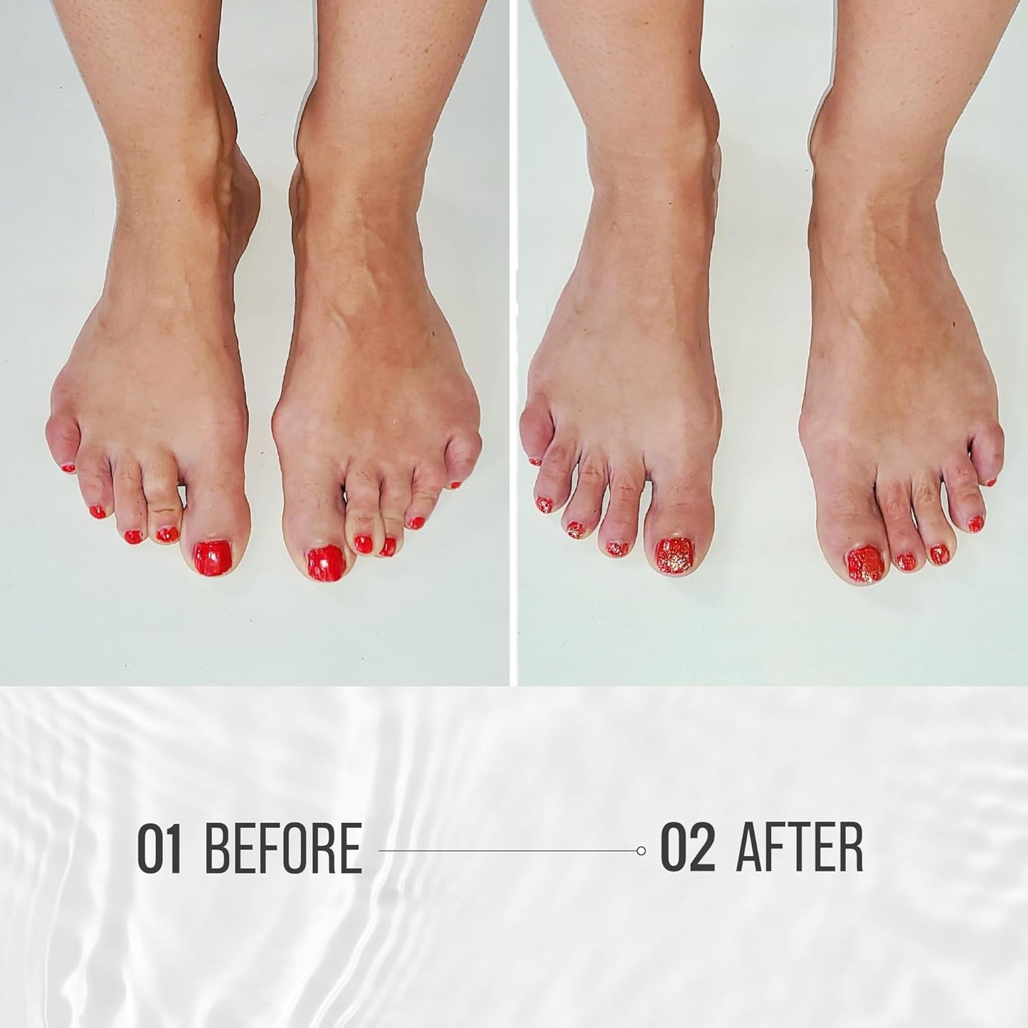 TRIHARD Toe Spacers | Foot Alignment & Bunion Relief | One Size Silicone Yoga Toe Separators & Post-Run Toe Corrector for Mobility & Pressure Relief