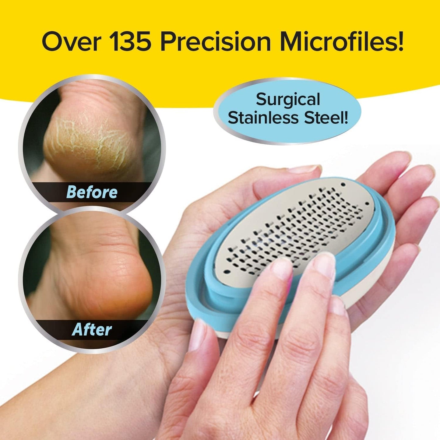 PedEgg Classic Callus Remover, As Seen On TV, New Look, Safely & Painlessly Remove Tough Calluses Dry Skin to Reveal Smooth Soft Feet, 135 Precision Micro-Blades, Traps Shavings