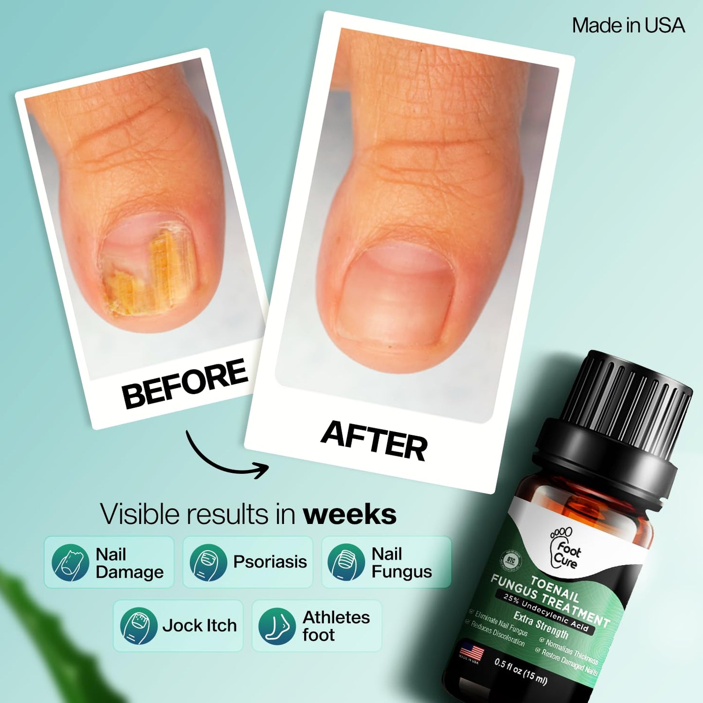 FOOT CURE Toenail Fungus Treatment for Fingernails, Nail repair, Toenail Softener, Yellow Toenail Treatment, Ingrown Nails and Foot Fungus Treatment Extra Strength (Pack of 1)