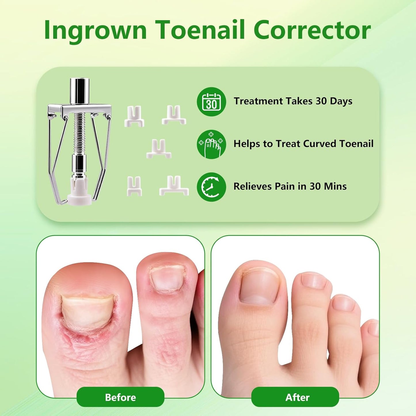 Ingrown Toenail Removal Kit - Professional Ingrown Toenail Treatment Tool Includes Ingrown Toenail Corrector Drops, Corrector Patch, Toenail Clipper, Nail File Lifter Pedicure Tools At Home