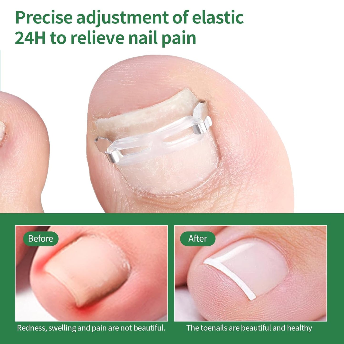 Ingrown Toenail Treatment, 10 packs Ingrown Toenail Corrector, Ingrown Toenail Removal Kit for Curved Nail Repair, Corrector for Man and Women All Size Toenail