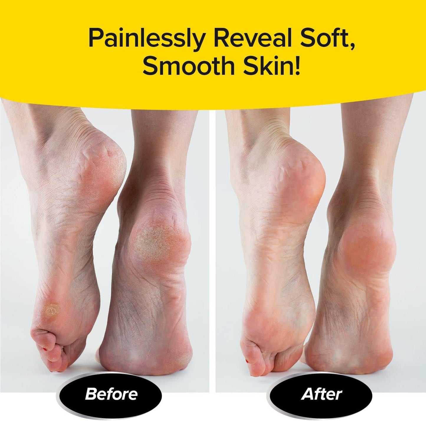 PedEgg Classic Callus Remover, As Seen On TV, New Look, Safely & Painlessly Remove Tough Calluses Dry Skin to Reveal Smooth Soft Feet, 135 Precision Micro-Blades, Traps Shavings