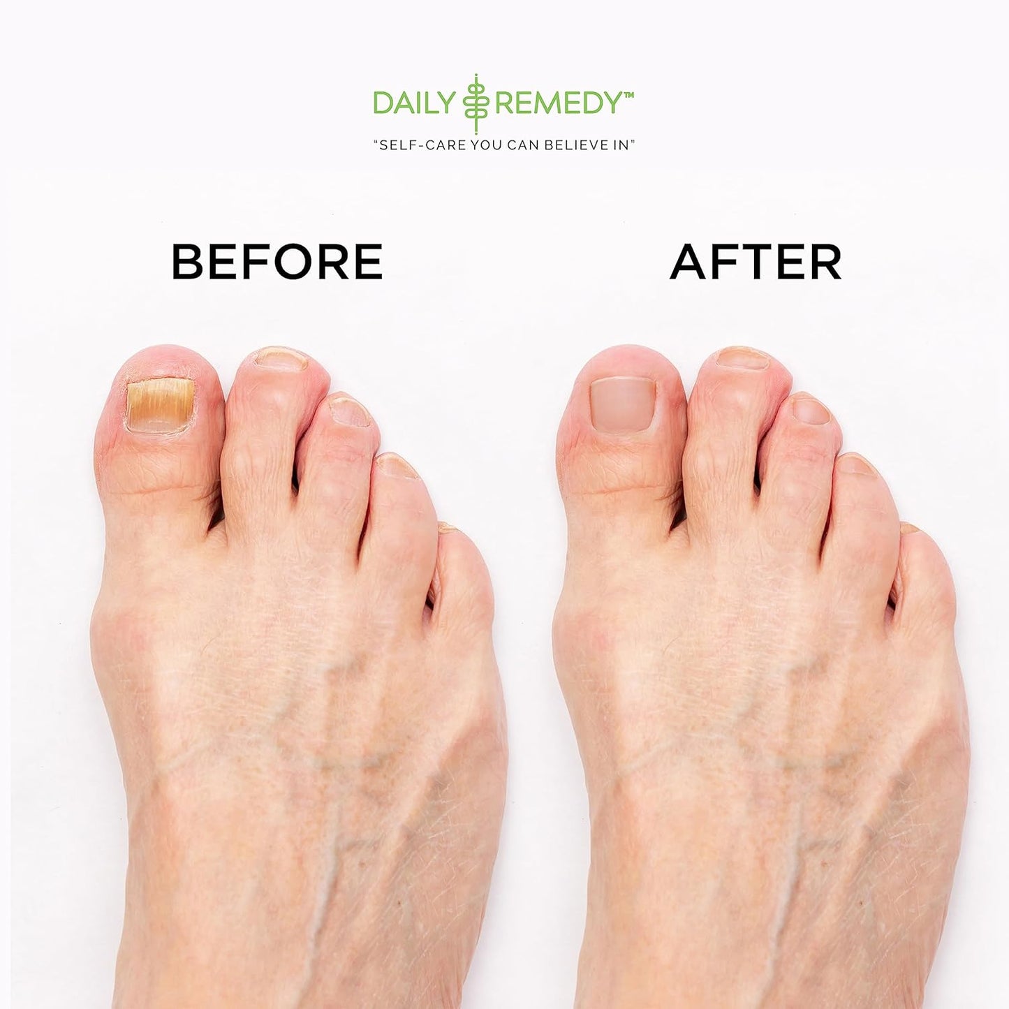 DAILY REMEDY EXTRA STRENGTH Tea Tree Oil Foot Soak w/ Epsom Salt Made in USA Toenails，Athlete's Foot，Itchy Feet，Stubborn Smelly Foot Odor，Pedicure Calluses & Soothes Sore Tired Achy Feet 16 oz，Black